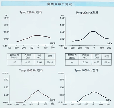 宽频声导抗鼓室图