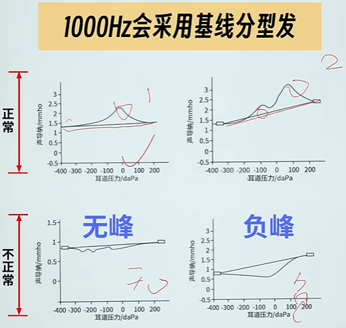 1000Hz鼓室图基线分型法