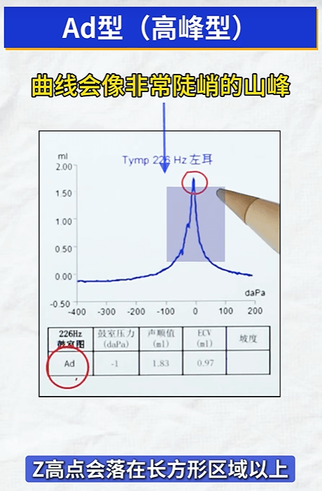 Ad型鼓室图