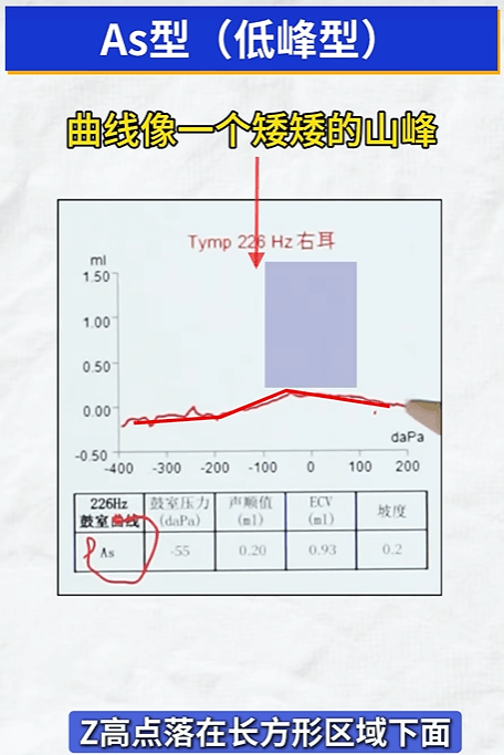 As型鼓室图