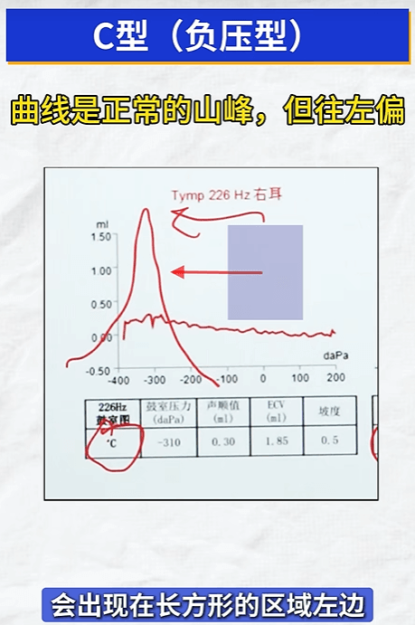 C型鼓室图