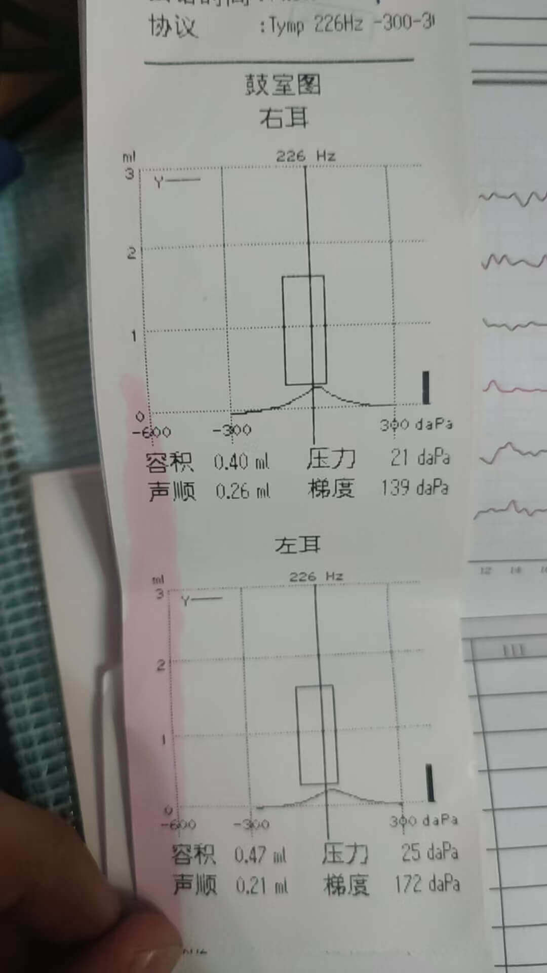 鼓室图检查报告
